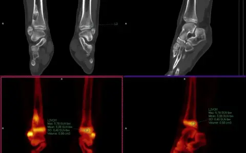 Co to jest SUV max i dlaczego jest kluczowy w diagnostyce medycznej
